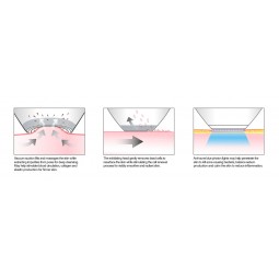 Microdermabrasion Facial Anti-Acne & Skin Resurfacing Technology